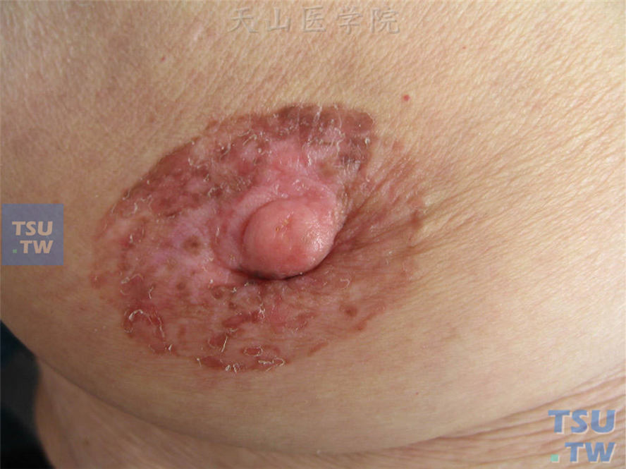 乳房Paget病：乳头及乳晕周围浸润性红斑，边界清楚，表面少许鳞屑，乳头内陷