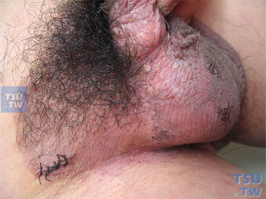 乳房外Paget病：阴阜、阴囊浸润性红斑，表面结痂