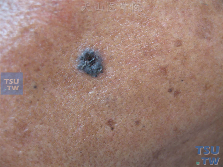色素性基底细胞癌，病史6年，表现为黑色斑疹，略隆起于皮肤表面，中央破溃结痂
