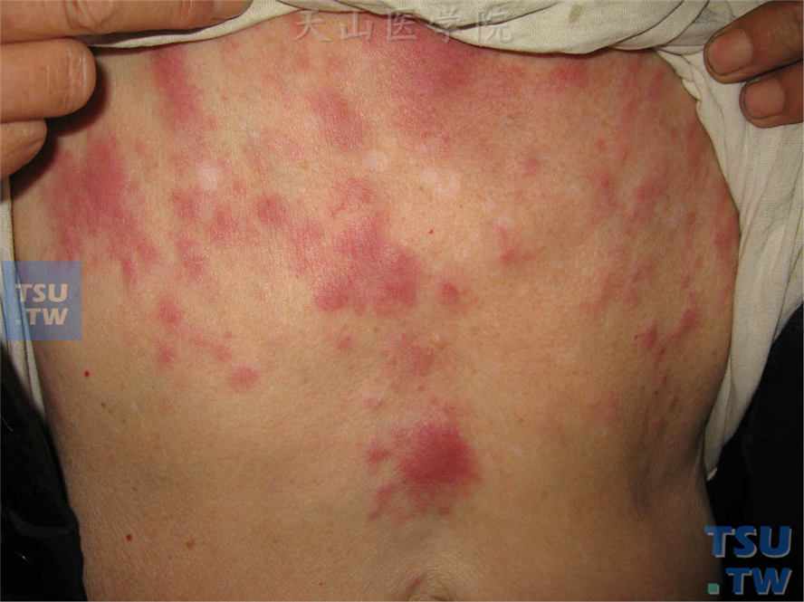淋巴瘤：前胸、上腹部紫红色斑块、斑丘疹