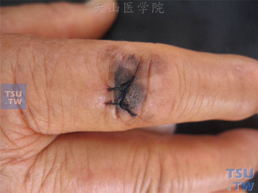 手指褐色斑疹，表面色素不均匀，形状不对称