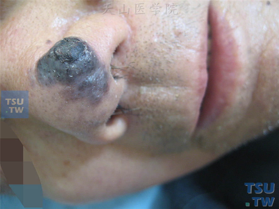 鼻部褐黑色斑疹，其上发生乳头瘤样增生，边缘不规则，形状不对称