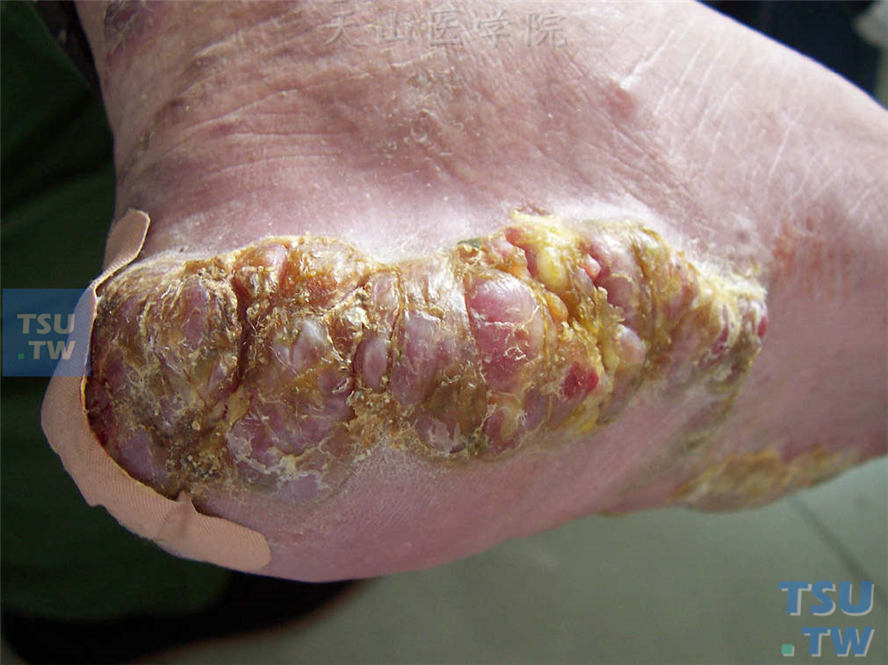 卡波西肉瘤（Kaposi’s sarcoma）足底融合性斑块、结节，质如橡皮