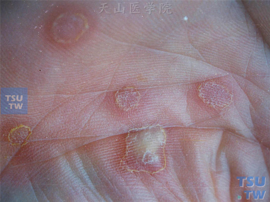 手掌脓疱疹