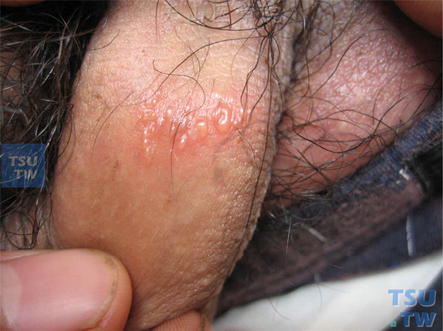 生殖器疱疹的症状表现