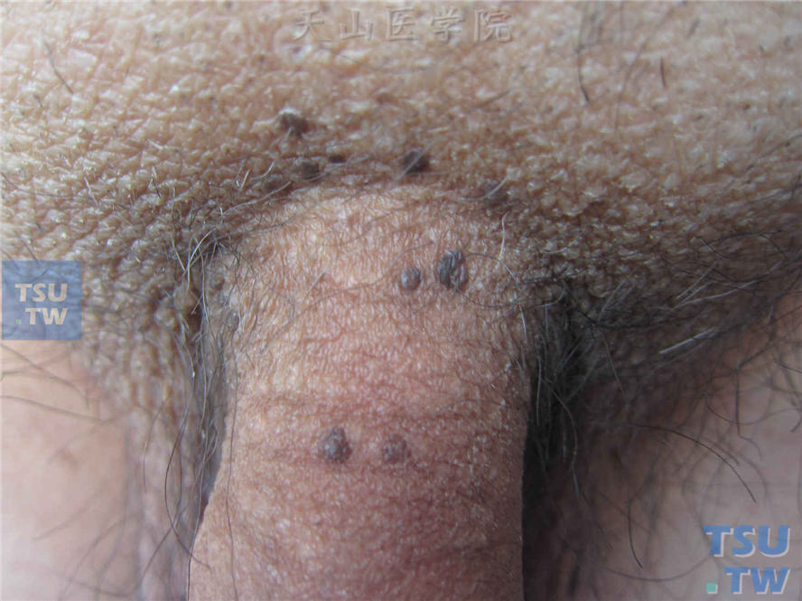 阴茎皮肤见多个褐色丘疹，类圆形，表面粗糙