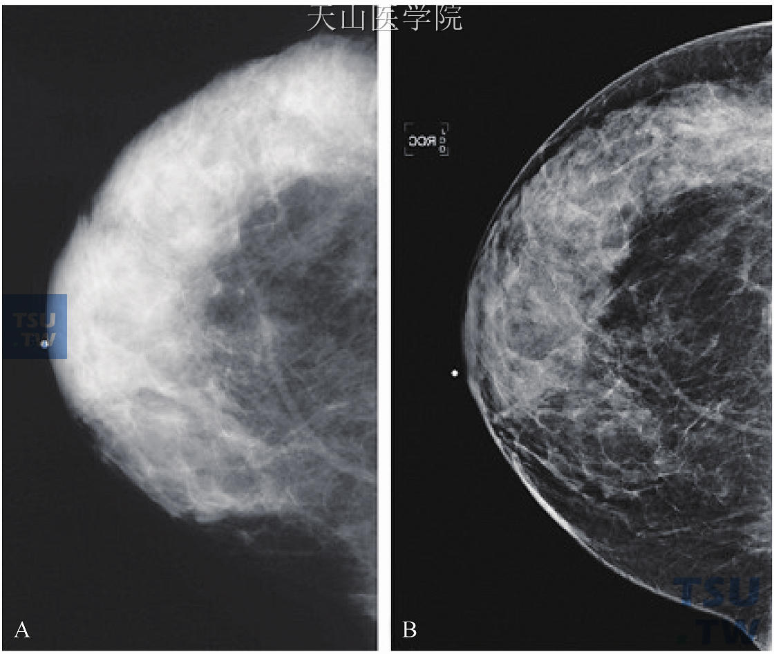 乳腺癌的数字化乳房X线照相术