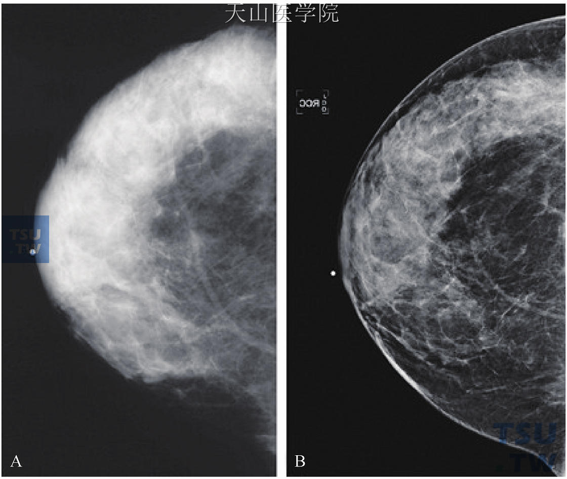 使用屏幕胶片成像（A），该患者的乳腺组织看起来很致密，对比度较小，不容易看出乳腺癌的可能，跟正常组织差别不大。1年之后，又做了全数字化乳房X线摄影（B），可以看出动态变化，并提供了较大的组织对比度