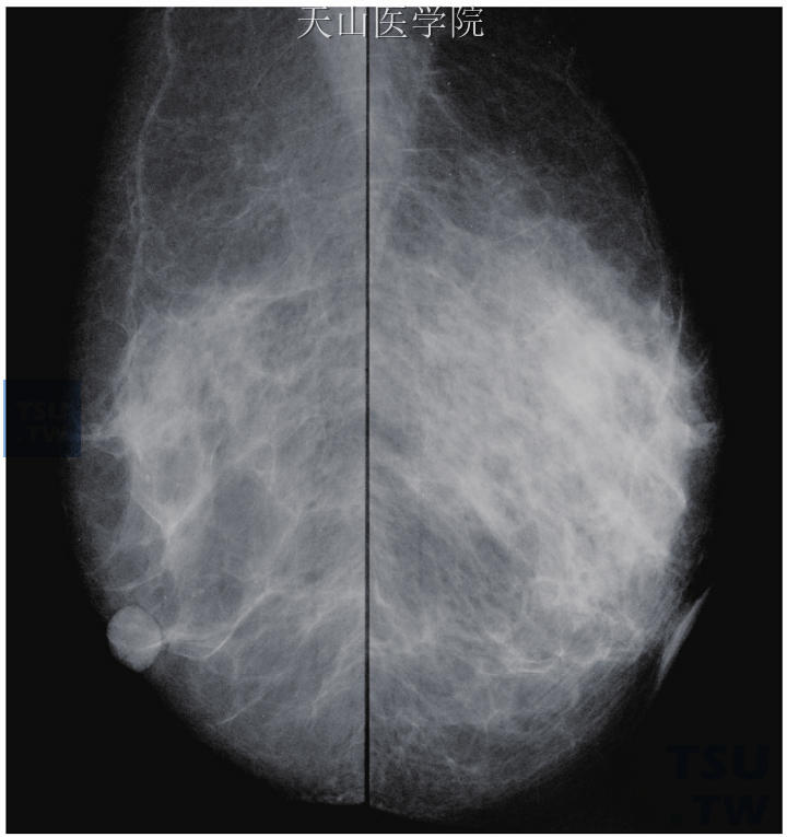 左乳的团状不对称致密是在比较了双侧乳腺片后才发现