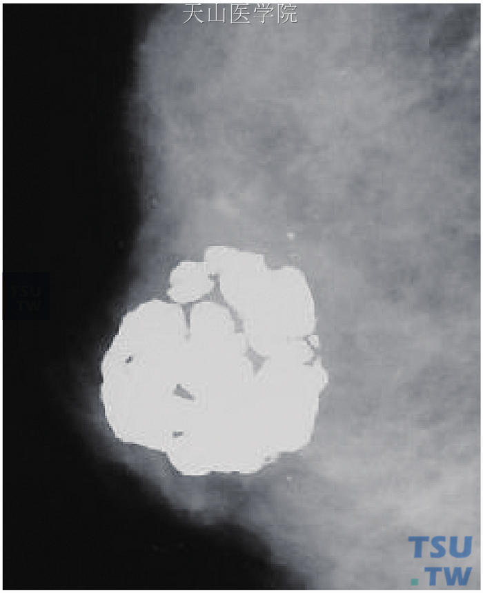 右乳头后方大块状钙化为退变纤维腺瘤的典型表现