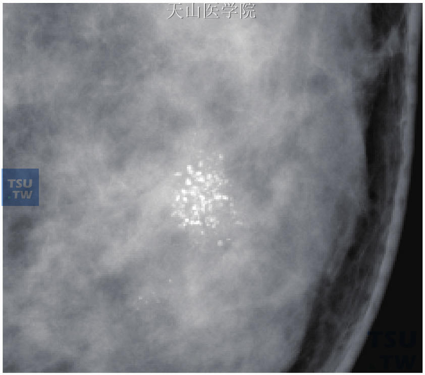 DCIS可以表现为簇状分布的多形性钙化，是最常见的一种表现形式