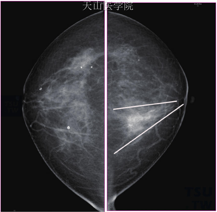  图9-14　左乳内侧两条线之间段样走行的局灶性不对称致密，也可以是DCIS的一种表现形式，此征象在比较双乳相同体位图像后显示更明显