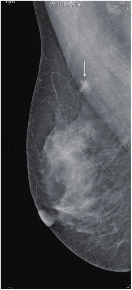 右乳上方分叶形高密度肿块，边缘浸润，为浸润性导管癌