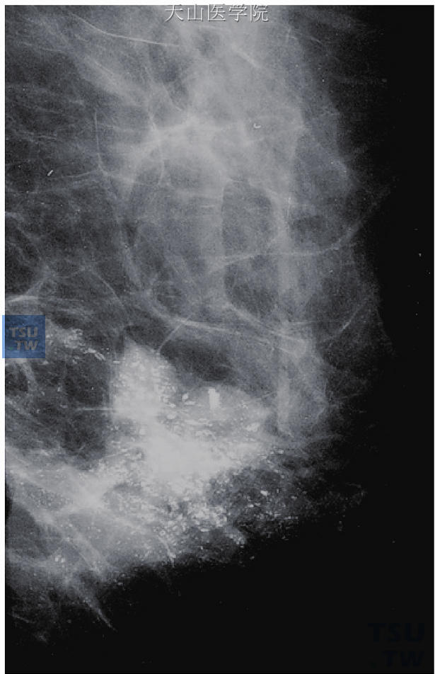  图9-16　左乳较大不规则肿块，边缘浸润，伴有肿块内较多（超过10枚）不均质的颗粒状钙化