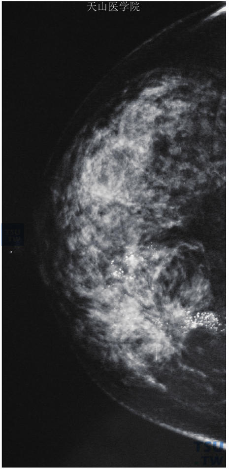 右乳内侧结构扭曲伴有多量颗粒状恶性钙化，这种征象仅出现在浸润性导管癌中
