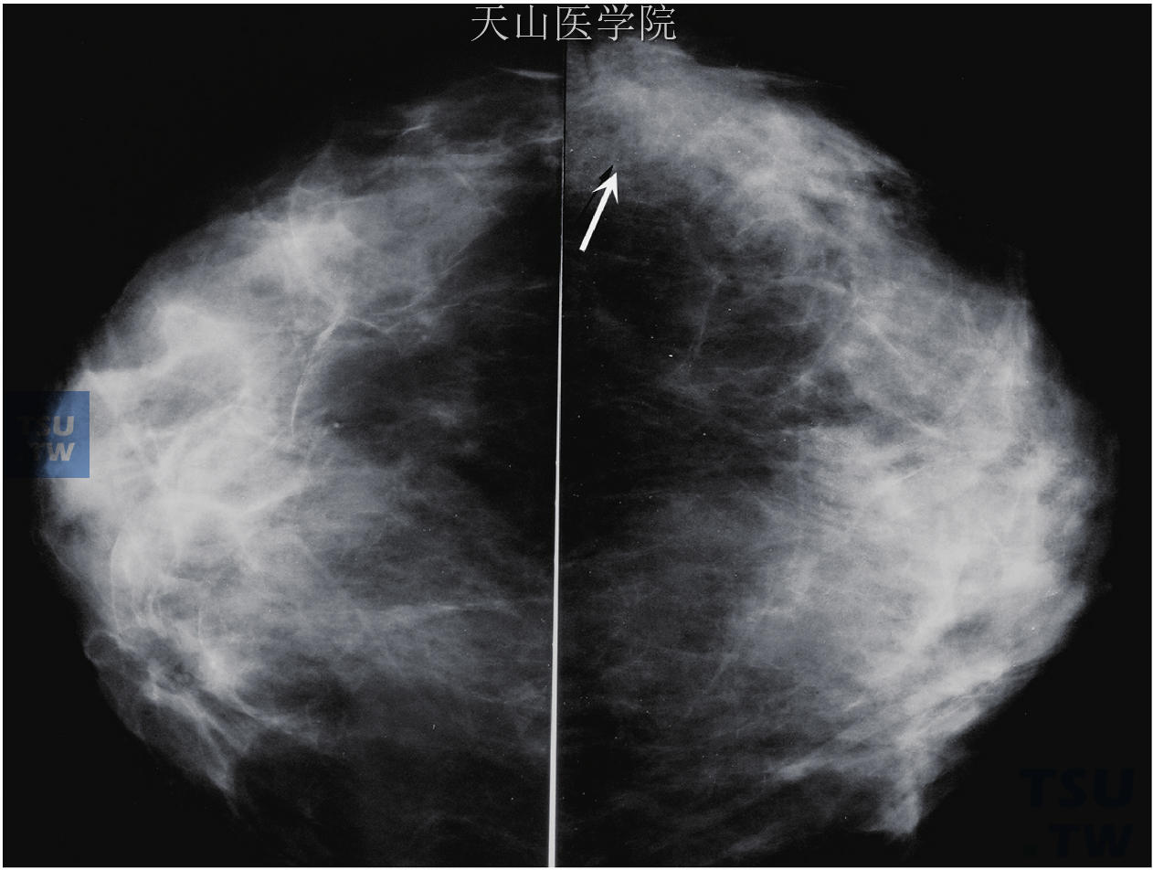 左乳外侧致密，局部结构较紊乱，征象不甚明显，需要比较双侧才能发现，是浸润性小叶癌的一个较为典型的特征