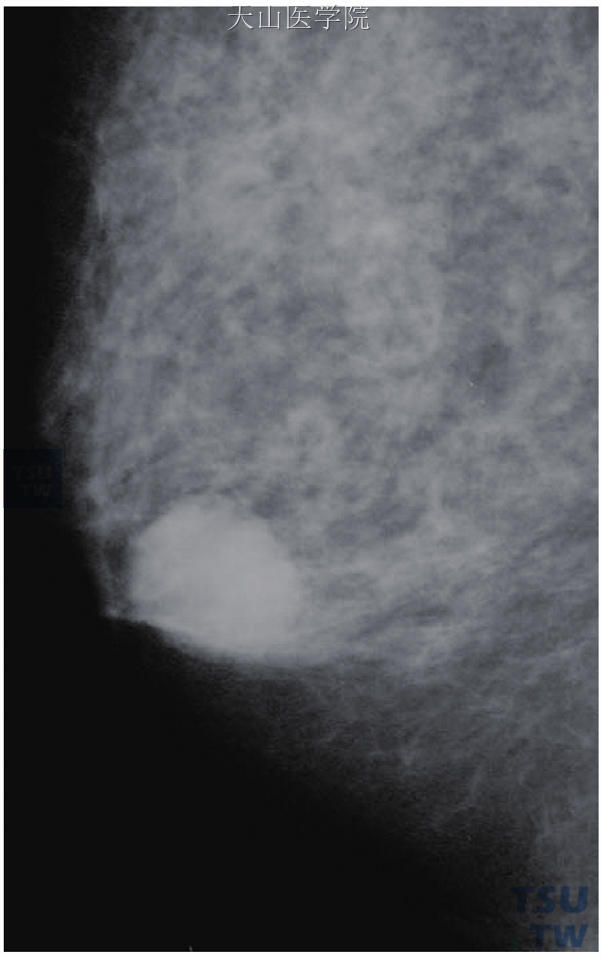 右乳晕后方较高密度肿块，大部分边缘清晰光整，后方边缘呈小分叶改变，为髓样癌