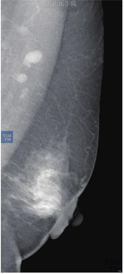 左乳佩吉特病伴乳腺内浸润性导管癌。左乳晕区皮肤增厚，乳晕下导管增粗。乳腺实质结构紊乱，但未显示明显肿块等改变。在中央区深部见数枚钙化，提示病变不仅仅局限在乳头-乳晕区