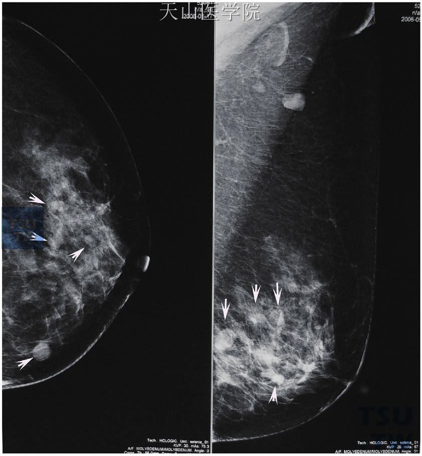 左乳内多发性转移，患者有对侧乳腺癌手术史。乳腺内可见较多大小不等、边界清晰的类圆形结节影