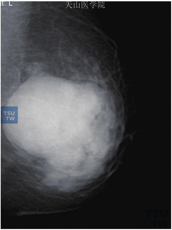 左乳良性分叶状肿瘤。左乳中央区边界清晰肿块，前缘呈明显的分叶状改变