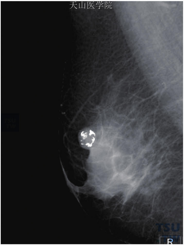 右乳上方边界清晰肿块，伴粗大钙化，是为退变纤维腺瘤的典型X线表现