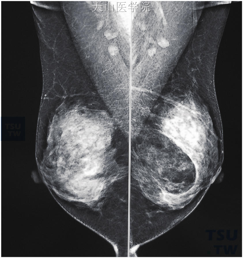 乳腺良性肿瘤的X线表