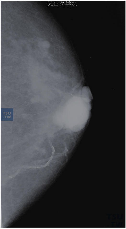 导管内乳头状瘤表现为乳晕后高密度结节，乳头尚未被牵拉移位