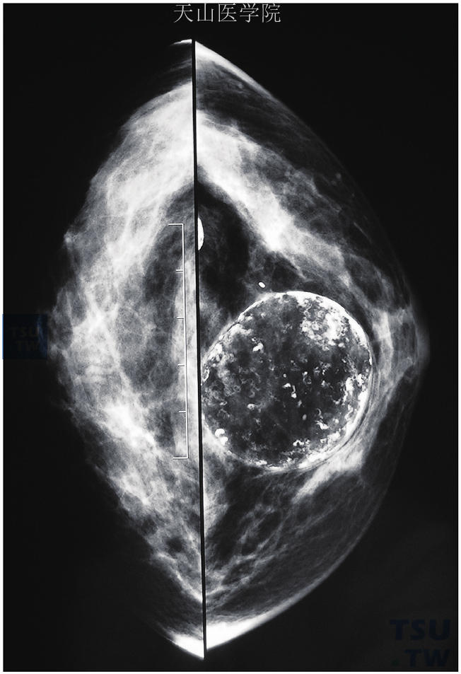 乳腺炎症性病变的X线表现