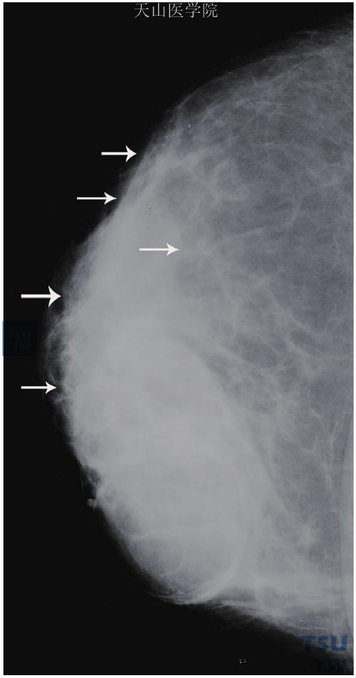 右乳浆细胞性乳腺炎，X线显示右乳晕区片状致密影，边缘呈火焰状改变