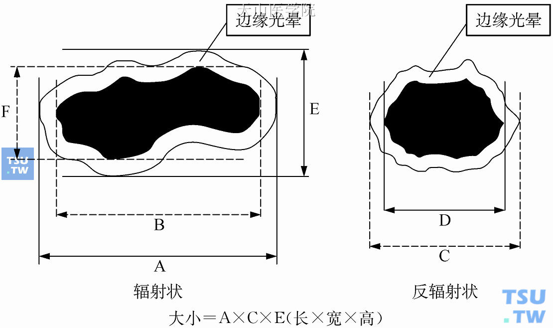 乳房肿块超声大小测量示意图