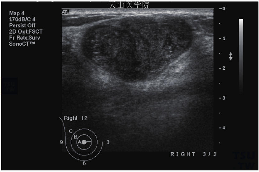 分叶状肉瘤，超声渡显示3.9×2.59cm的混合低中回声肿瘤，内部有瓣状结构