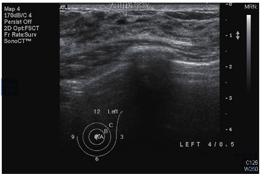 乳管内乳头状瘤，超声波显示0.3cm高回声突出物在扩张的乳管内，病理报告乳头状瘤