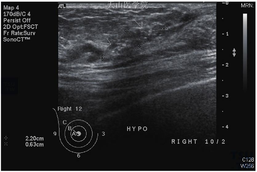 原位癌，超声波显示不规则的乳管扩张伴有亮点（疑似钙化点）