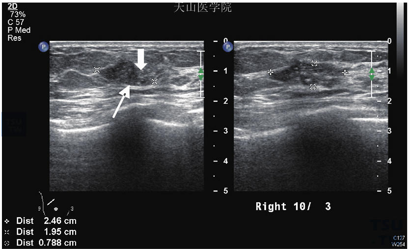 原位癌，超声波显示未见边缘光晕（粗箭头），也未呈现后部回声衰弱（细箭头）