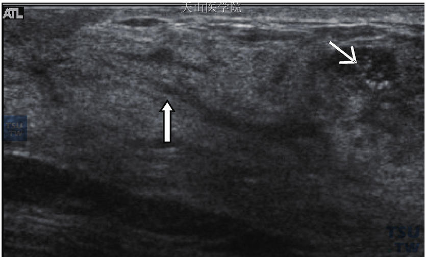 原位癌乳管内扩散，超声波显示低回声，因肿块伴有钙化点（小箭头），沿此肿块可见乳管扩张并延伸至乳头（大箭头）