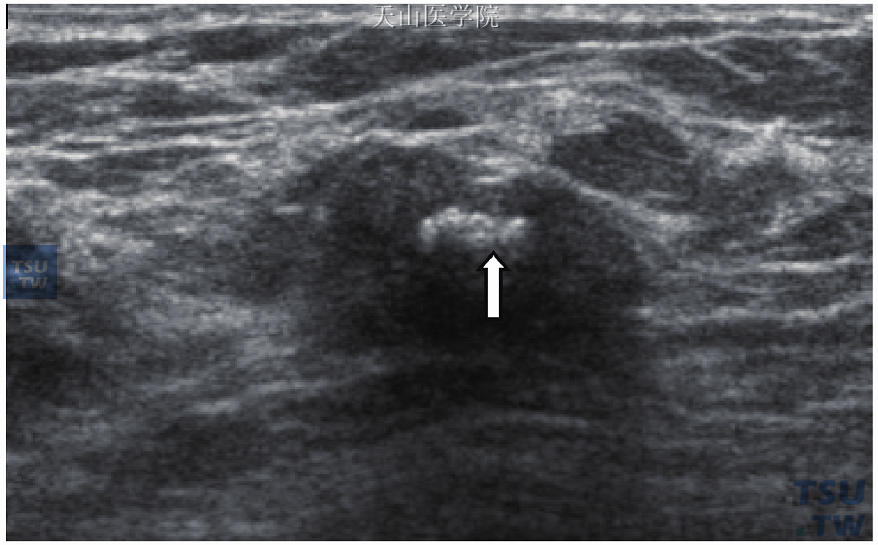 爆玉米花似钙化点（箭头处），为良性钙化点特征
