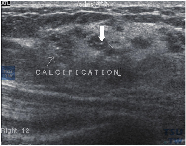 原位癌，超声波显示腊肠状乳管扩张（大箭头处）并有钙化点（小箭头处）