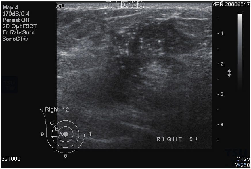 炎性乳腺癌超声图片图片