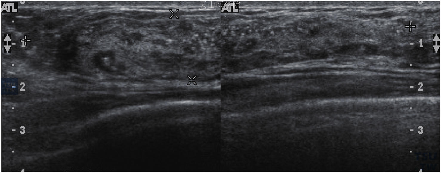 炎性乳腺癌超声图片图片