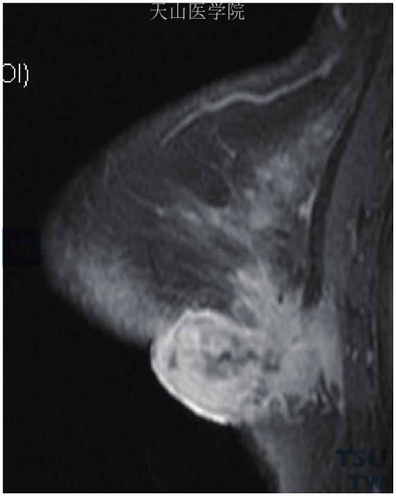 右乳浸润性导管癌，肿瘤累及皮肤、乳后脂肪间隙及胸肌