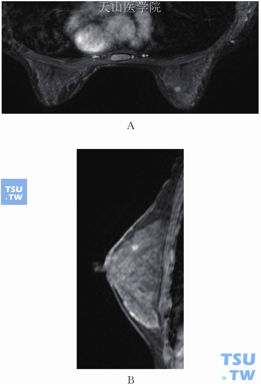 右乳内上象限近中线斑点状强化，周围见长毛刺，良性的可能性大，BI-RADS 3。MRI体表定位病灶距横断面及矢状面的垂直距离分别为4.7mm（A）及17.5mm（B）。术后病理检查为右乳硬化性乳腺病