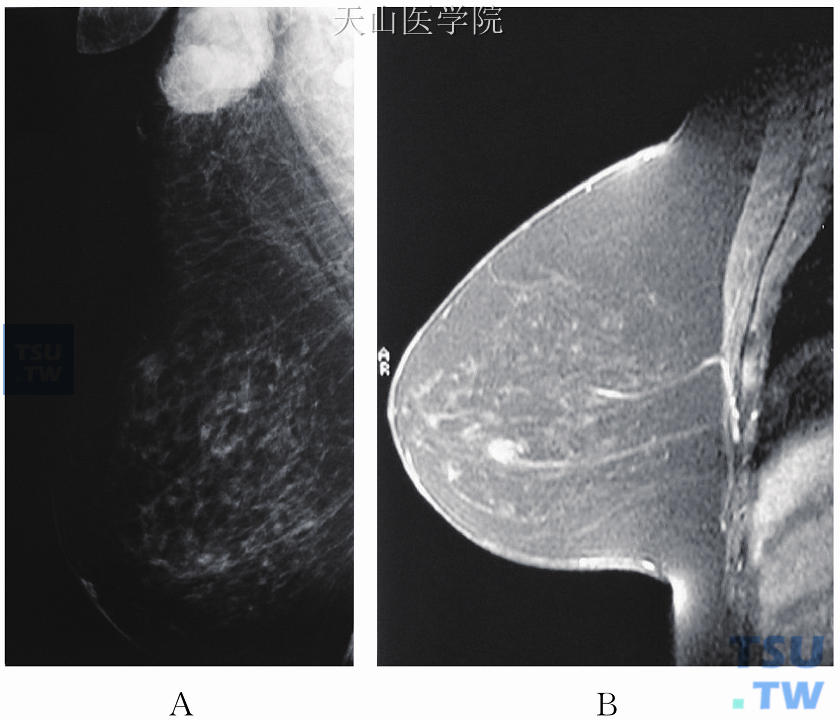 右腋窝淋巴结肿大，病理检查为腺癌，钼靶检查示右腋窝淋巴结肿大，右乳内未见明显异常，BI-RADS 1（A）。增强MRI矢状位示右乳下方强化小结节，术后病理检查为导管原位癌（B）