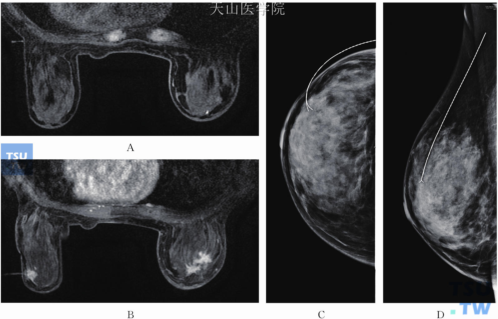 左乳仅MRI提示外上可疑病灶，BI-RADS 4。左乳外上病灶拟MRI引导下定位：（A）显示Marker；（B）显示穿刺套管的中心位于病灶的中央；（C，D）MRI引导下定位术后常规钼靶摄片，显示定位针位于左乳外上（进针深度为针的总长度减去进针后体外针的长度）。左乳外上病灶术后病理检查为左乳乳腺病伴间质胶原化。钼靶、B超及MRI均提示右乳外上恶性病变，BI-RADS 5。右乳单纯切除术后病理检查为以导管原位癌为主的浸润性导管癌，呈多灶性