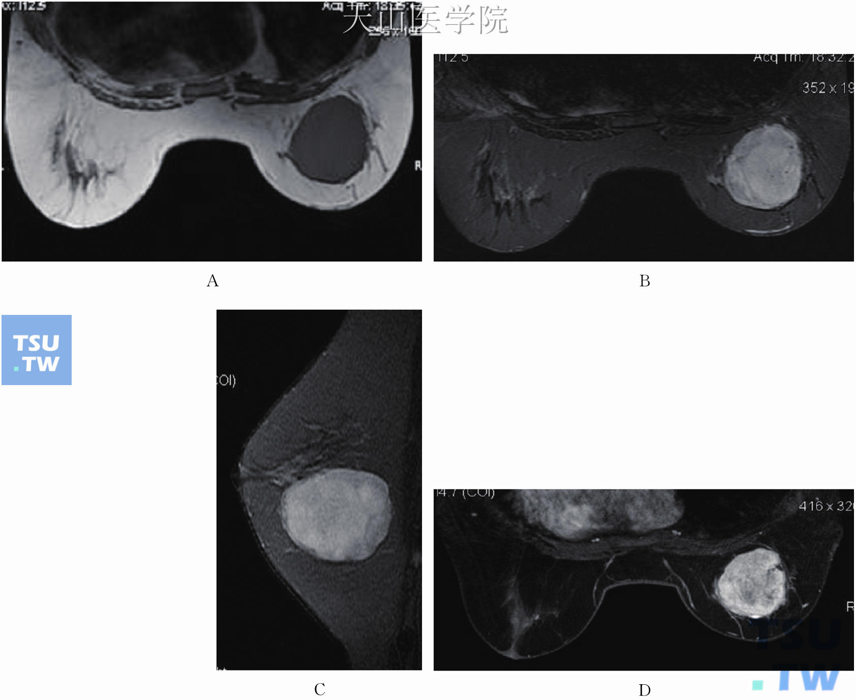 右乳恶性分叶状肿瘤。右乳外下近中线类圆形肿块，T1WI为低信号（A），抑脂序列的轴位（B）及矢状位（C）T2WI为不均匀高信号；轴位增强示不均匀异常强化，部分边缘光整，部分欠锐利（D）