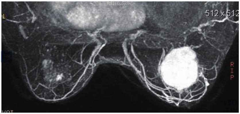 为图11-5患者，通过图像后处理显示右乳内圆形肿块异常强化，周围血管较对侧增多、增粗，同时可显示双侧胸廓内动、静脉