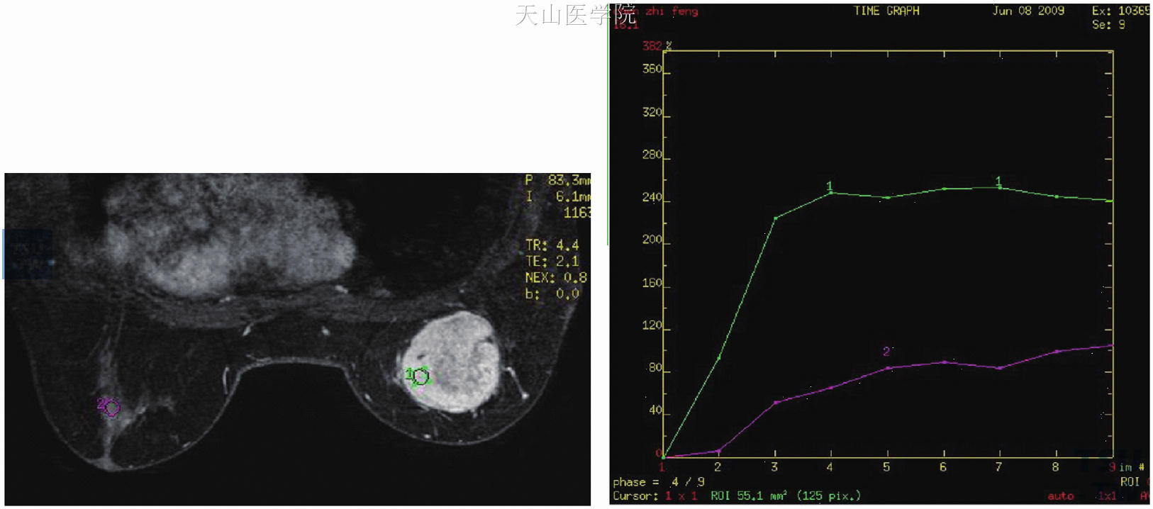 为图11-5患者，时间-信号曲线为平台型