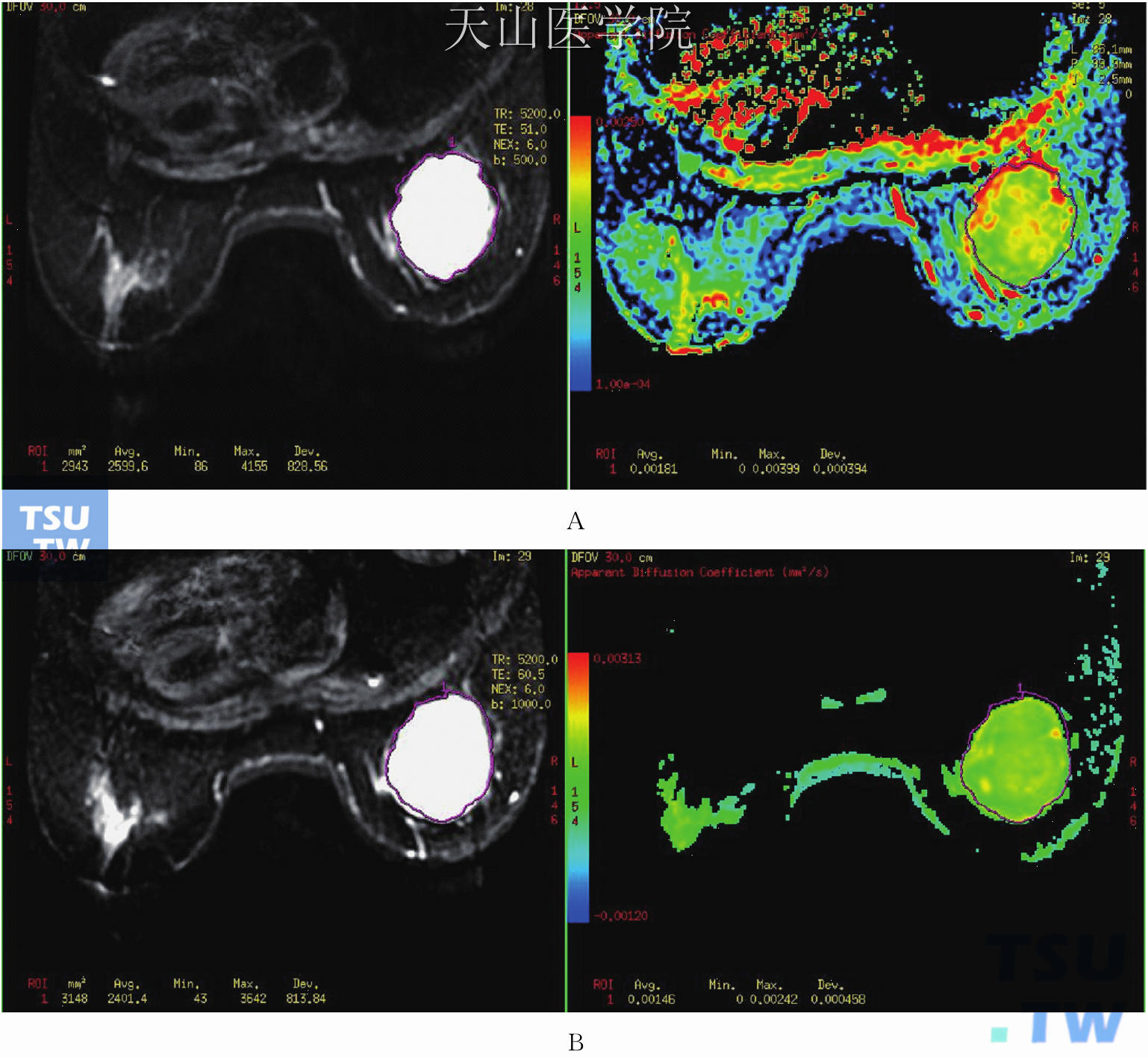 　为图11-5患者的DWI，b值=500（A），b值=1 000（B）
