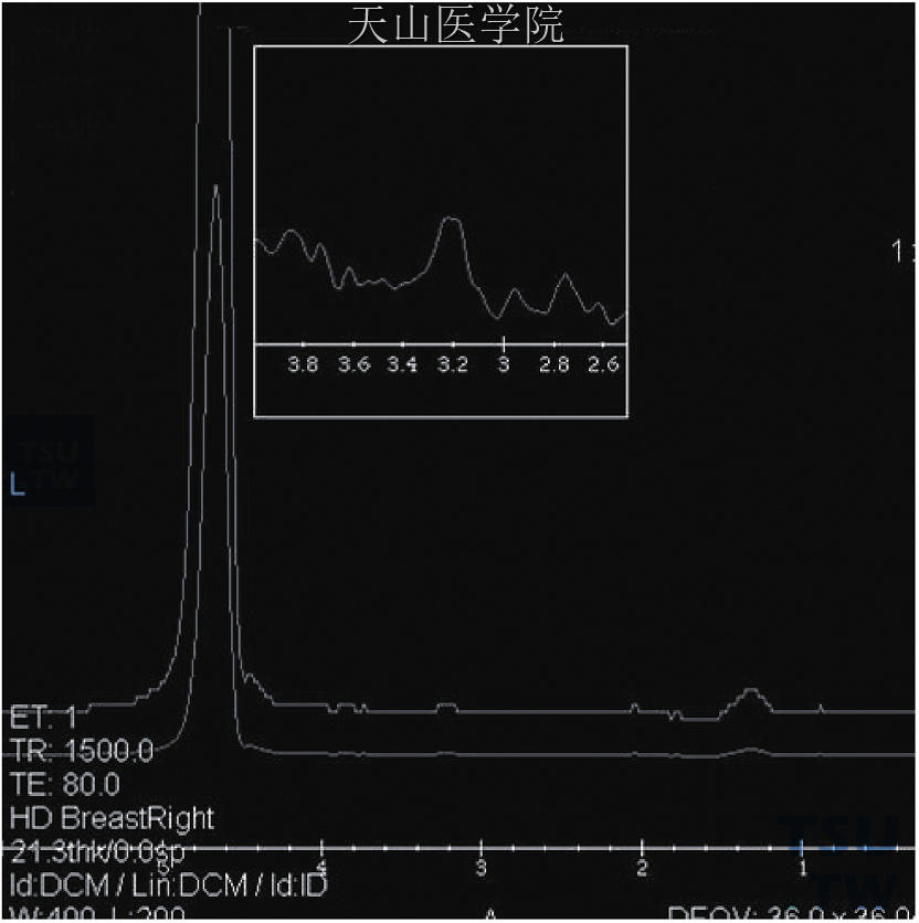 为图11-5患者的1H-MRS