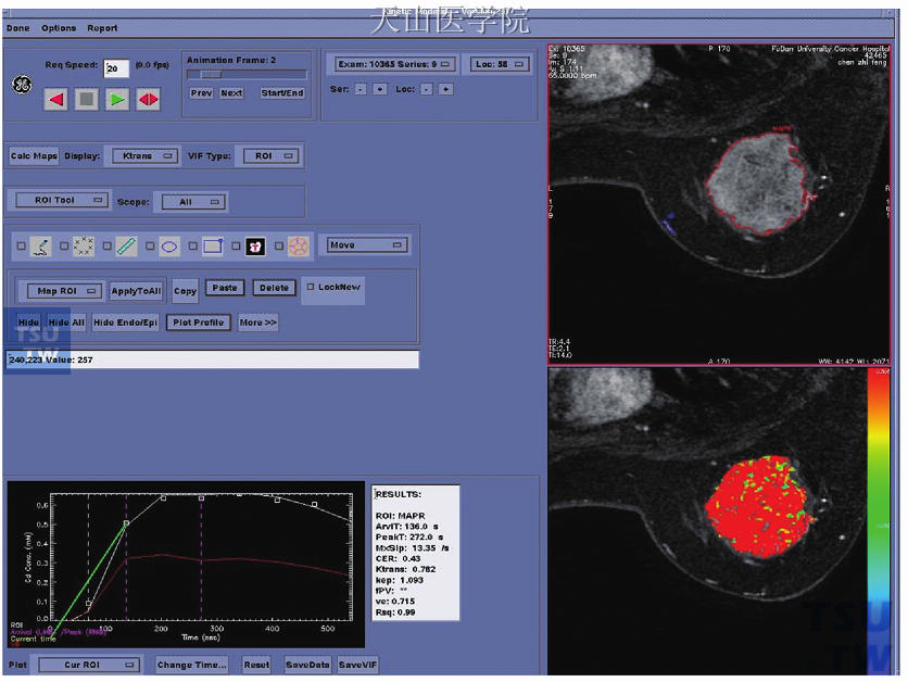 为图11-5患者的DCE-MRI