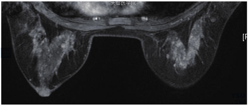 两乳内散在多个斑点状强化灶